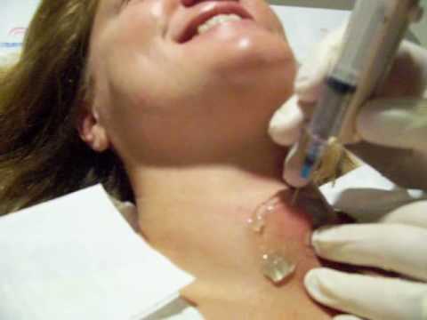 биопсия узла щитовидной железы